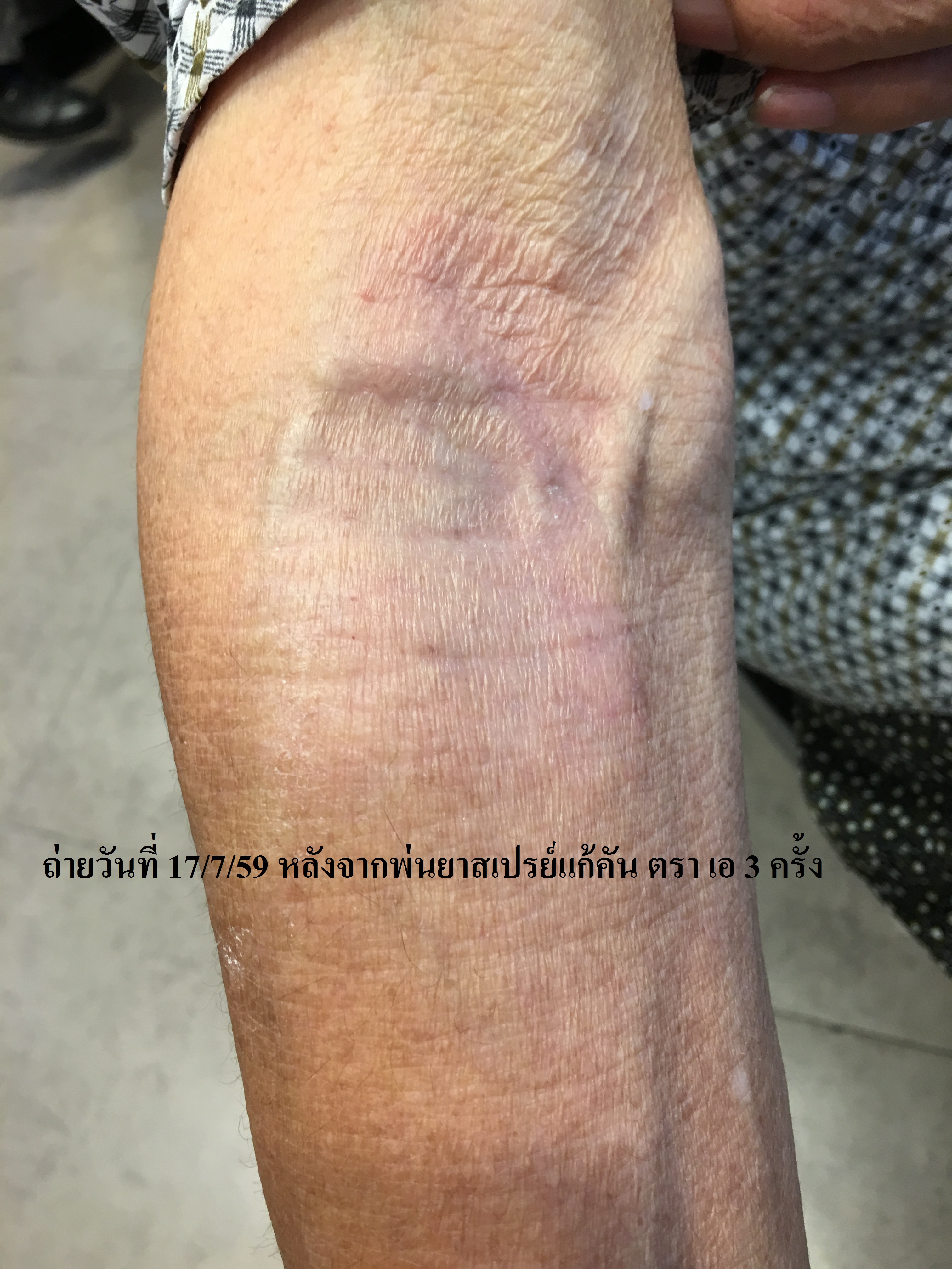 ยาแก้อาการคันจากเชื้อรา ยาสเปรย์ทาแก้คัน ตรา เอ